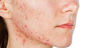 The efficacy of topical metronidazole in the treatment of ocular rosacea. Acne E Alimentazione Latticini E Zuccheri Sono Da Evitare