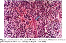 This activity is supported by clovis oncology, inc., pfizer and a grant from genentech. Scielo Brasil Prostate Carcinoma With Neuroendocrine Differentiation Case Report And Literature Review Prostate Carcinoma With Neuroendocrine Differentiation Case Report And Literature Review
