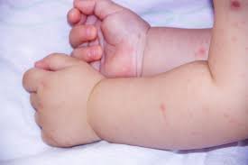 Hal ini agar tindakan yang nantinya kita ambil untuk mengatasi bisa tepat dan cepat. Jangan Terlambat Ditangani Ini Bedanya 3 Penyakit Dengan Gejala Ruam Dan Demam Pada Bayi Orami