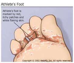 Athletes Foot Treatment Symptoms Advanced Foot Ankle
