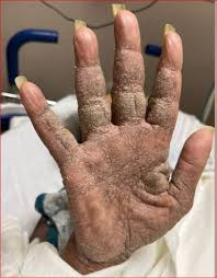 Image result for scabies norvegica