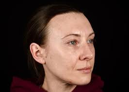 Cosmetic Surgery, Botox & Fillers Glasgow