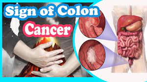 Cologuard detects colon cancer even before it becomes symptomatic. Signs And Symptoms Of Colon Cancer You Should Not Ignore Youtube