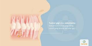 We did not find results for: Tumor Gigi Tanda Dan Gejala Penyebab Cara Mengobati Cara Mencegah