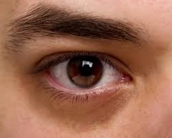 Penyebabnya dapat berupa apa saja, tetapi kita dapat mencoba berbagai macam perawatan. Pengobatan Mata Kering Kmn Eyecare