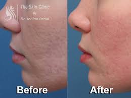 Thank you for visiting my website. The Skin Clinic By Dr Jebina Lama Best Place For All Kinds Of Skin Related Services And Treatments