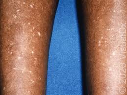 Image result for Pigment stains on the shin