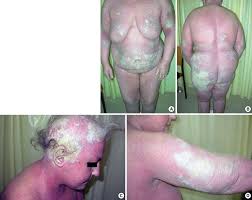 Image result for scabies norvegica