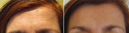 Pour les atténuer, le botox supplante désormais le lifting frontal. Rajeunissement Du Regard Sans Chirurgie Dr Benouaiche