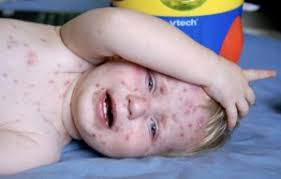 1st day biasa memang sikit, 2nd day baru kuar semua. Bila Anak Kena Chicken Pox Ikut Nasihat Pemakanan Oleh Doktor Ini Keluarga