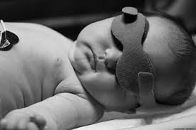 During phototherapy your baby will be placed on his or her back unless they have other conditions that prevent this. Jaundice Hyperbilirubinemia