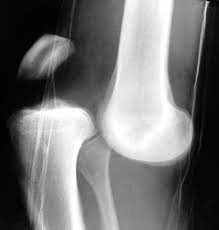 Joint swelling, stiffness (particularly in the morning) and creaky/noisy knees; Applied Basic Sciences Section 5 Postgraduate Orthopaedics