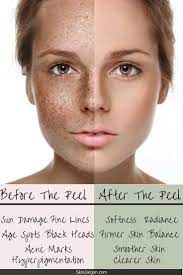 Experience A New Kind Of Exfoliation With Chemical Peels Learn More At Skinjargon Com Chemical Peel Skin Hyperpigmentation Facial Aesthetics