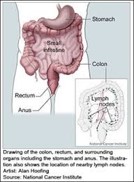 Another characteristic symptom of bowel cancer is the appearance of an aversion to meat foods. Bowel Cancer Lab Tests Online Au