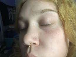 Any ideas for raised red/purple spots