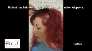 Since 1996, people all over the world have turned to this revolutionary product to combat their hair loss. Video Hair Transplant For Female Traction Alopecia Using Dr Ugraft