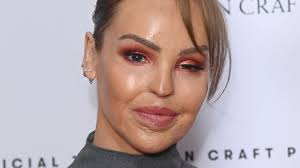 Nach Säureangriff: Das half Katie Piper bei ihrer Genesung