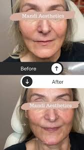 That jawline & chin combo for the win👌🏾 , Ready for your glow up?, 💉All  treatments are customized to enhance your natural beauty, 📍1860 Queen St  E, Suite 5 (2nd Floor), Toronto, 💌DM or booking link in ...