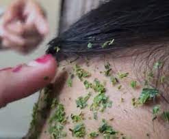 Ia menggunakan kain putih yang dinyalakan api sambil diletakkan pada keseluruhan muka secara berperingkat. Nak Ulat Resdung Tergedik Gedik Keluar Baiki Dara Kulit Facebook