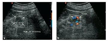 Ackd And Rcc Rcc In Ackd Often Appears As An Exophytic Solid Hyperechoic And Small Nodule Therefore It Can Be Easily Mi Women Fashion Women S Top