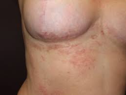 Natural treatments natural remedies lichen planus pictures lichen planus cure lichen lichen planus is an inflammatory immune system issue of your skin or mucous membranes. Lichen Planus Images Dermnet Nz