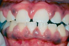 If dental plaque is not removed regularly from teeth, it can cause tooth decay and dental cavities (caries) or periodontal problems (such as gingivitis and periodontitis). Gingivitis An Overview Sciencedirect Topics
