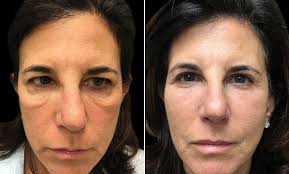 Festoon Surgery Before And After Image Puffy Eye Treatment Malar Bags Under Eye Fillers