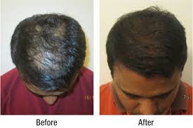 To find a solution for hair loss treatment in delhi is not a stressful task anymore because dermaclinix provide you the best hair loss and baldness treatment delhi which helps you regain you hair naturally and quickly. Richfeel Reviews For Hair Treatment At Richfeel S Delhi Clinic