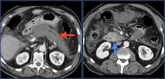 Image result for CT Intravenous Contrast