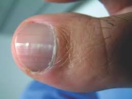 These melanomas can appear anywhere on the body including underneath fingernails and toenails. Keys To Diagnosing And Treating Dystrophic Toenails Podiatry Today