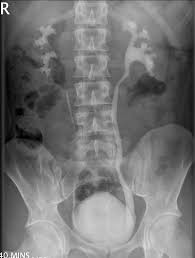 Renal Calculi Xray Google Search Renal Calculi Nursing Documentation Bladder