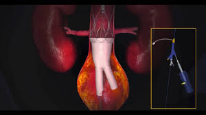 Acho que estou com algum problema no estômago. Aneurisma De Aorta Abdominal Dr Marcelo Kalil