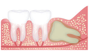 Check spelling or type a new query. Wisdom Teeth Removal Procedures Surgery Wood Myers