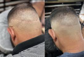 Before and after images 5 · step 1: The Best Scalp Micropigmentation Smp Clinic In Lexington Ma