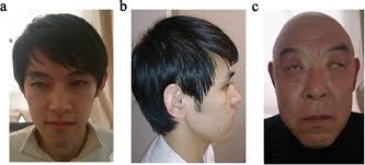 A novel small deletion in the NHS gene associated with Nance-Horan syndrome 