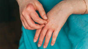 Eczema is a chronic skin condition which is characterized by dry skin, red patches, and itchiness. 7 Types Of Eczema Symptoms Causes And Pictures