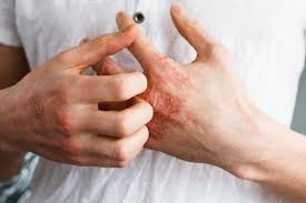 This skin infection causes symptoms like itching, redness of the skin and rashes. The Cure For Eczema Is Likely More Than Skin Deep Discover Magazine