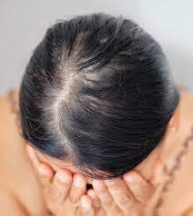 Gradual thinning on top of head, the most common type of hair loss, affecting both men and women as they age. Diffuse Hair Loss Causes Signs And Treatment Options