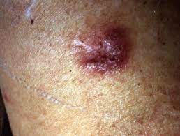 Cey med j 1 988 ; Cutaneous Tuberculosis Dermnet Nz
