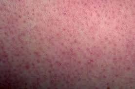 That's where the reddit thread comes in—it's full of product recommendations, lifestyle changes, and helpful hacks to lessen the appearance of bumpy skin. Quick Facts Keratosis Pilaris Msd Manual Consumer Version