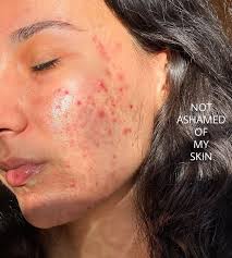 Maia Gray (@its_just_acne) • Instagram photos and videos