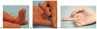 A new test, called the dip extension test, to diagnose isolated flexor digitorum superficialis tendon injuries is described. Repair Of Acute Digital Flexor Tendon Disruptions Musculoskeletal Key