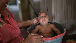 These are final 2015 data reported to arbonet for zika virus disease. Cdc Evidence Definitively Shows Zika Causes Birth Defects