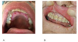 Discoid lupus erythematosus (dle), sometimes called chronic cutaneous lupus erythematosus, is a form of lupus that affects only the skin. Jcm Free Full Text Main Oral Manifestations In Immune Mediated And Inflammatory Rheumatic Diseases