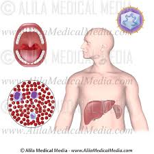Mono refers to the symptoms of infection, and ebv is the most common. Infectious Mononucleosis Alila Medical Images