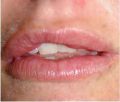 This includes sunbathing, tanning, saunas, hot tubs, or hot wax. Lumps After Dermal Fillers Best Clinic Sydney For Dermal Fillers