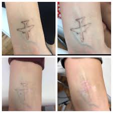 Results can start to be seen around the 3rd session. Laser Tattoo Removal New London Ink Tattoos