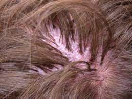 Left untreated, folliculitis can cause permanent skin damage including scarring, dark spots and permanent hair loss. Folliculitis Decalvans Dermnet Nz
