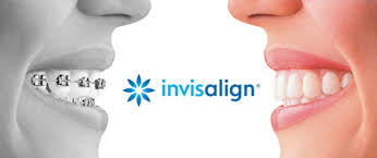 Résultats de recherche d'images pour « invisalign »