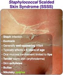 A skin infection characterized by damaged, shedding skin patches, staphylococcal scalded skin syndrome is a progressive disorder. Staphylococcal Scalded Skin Syndrome Dermatology Nurse Medical Knowledge Nursing School Studying